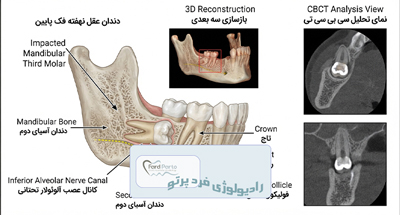 دندان نهفته چیست؟ علل، علائم و نقش CBCT در تشخیص | فردپرتو تهران